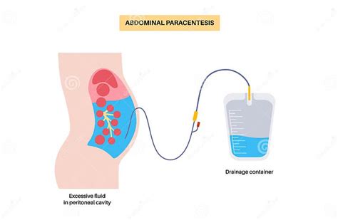 Abdominal Paracentesis Poster Stock Vector - Illustration of peritoneum ...