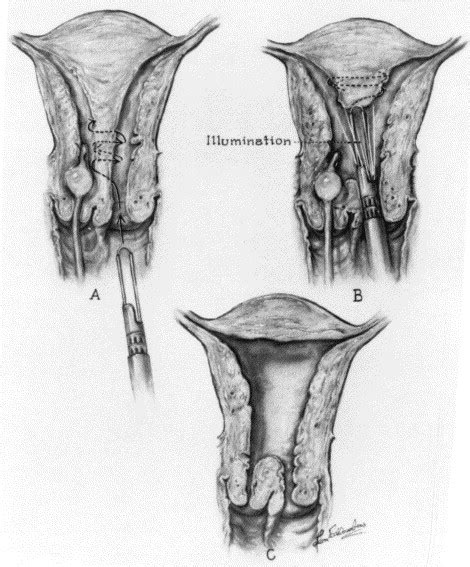 Hysteroscopic metroplasty of the Class Va uterus with preservation of ...