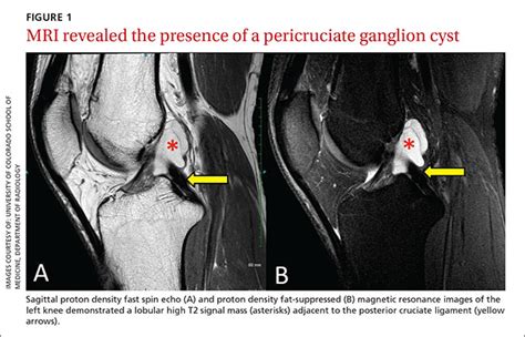 Pcl Ganglion Cyst Mri