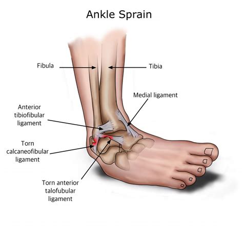 How to Recover from an Ankle Sprain | QiVantage