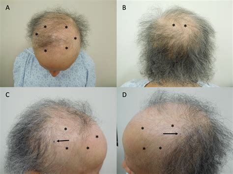 Cureus | Persistent Alopecia in a Breast Cancer Patient Following ...