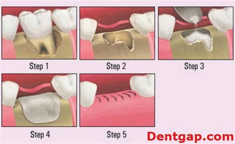 Why Tooth Extraction Aftercare is Important After Surgery # ...