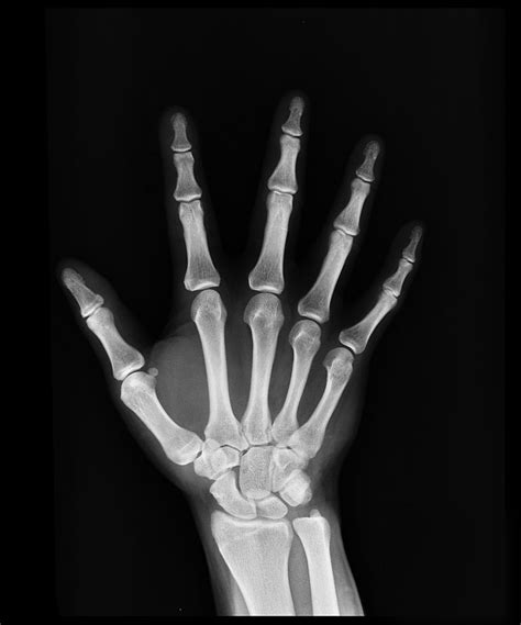 Hand X-Ray