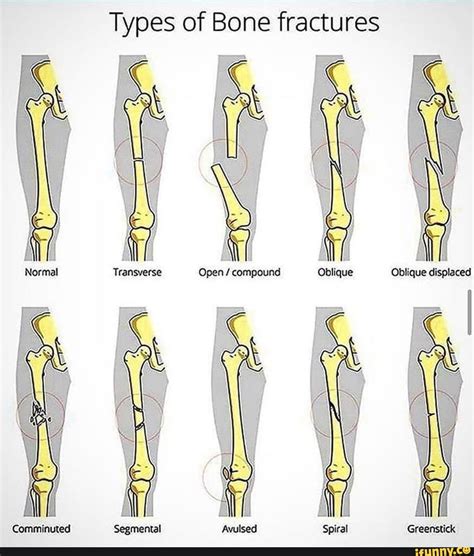 Greenstick Fracture