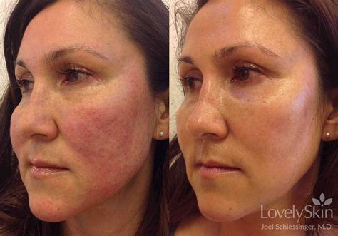 Rosacea Before & After Photos | Skin Specialists P.C.