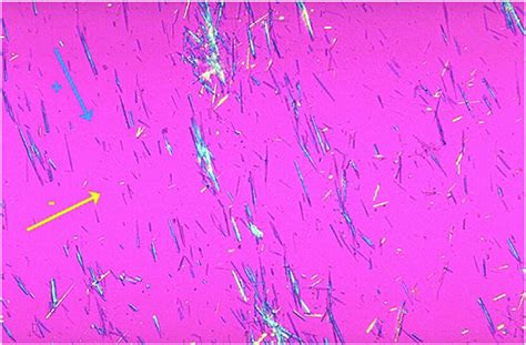 Synovial fluid. Yellow, needle-shaped negatively birefringent crystals... | Download Scientific ...