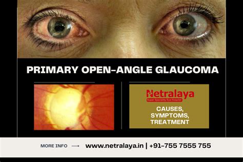 Primary Open-Angle Glaucoma: Causes, Symptoms, Treatment - Netralaya