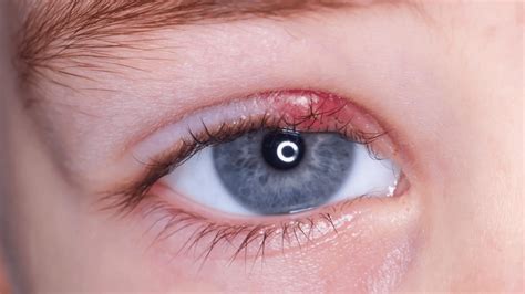What Is An Eye Stye? Causes, symptoms, and Treatment