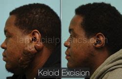 Keloids Dallas, Cosmetic Skin Procedures Plano, TX