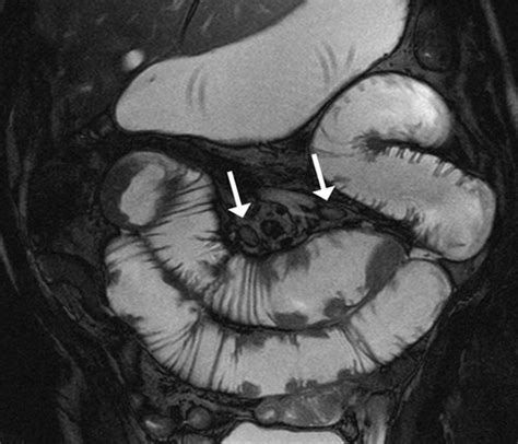 MR Enteroclysis in the Diagnosis of Small-Bowel Neoplasms | Radiology