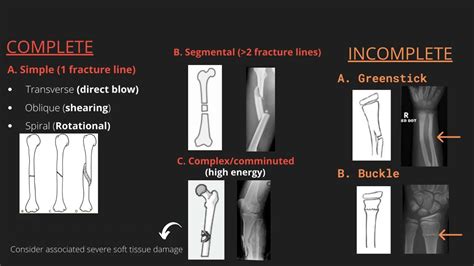 Approach to describing fractures on x-ray - YouTube