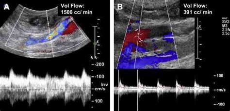 Femoral Av Fistula Ultrasound