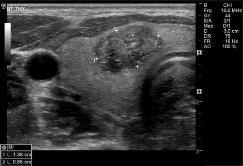 Thyroid Ultrasound