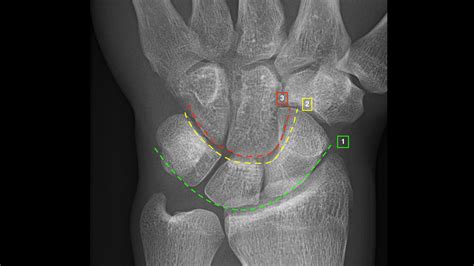 Carpal Bones Xray