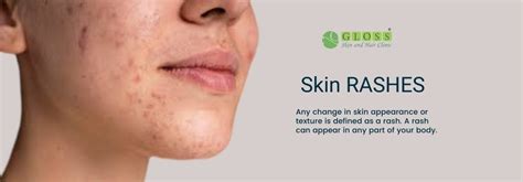 Skin Rashes treatment in Mumbai| Skin Allergies treatment in Andheri west