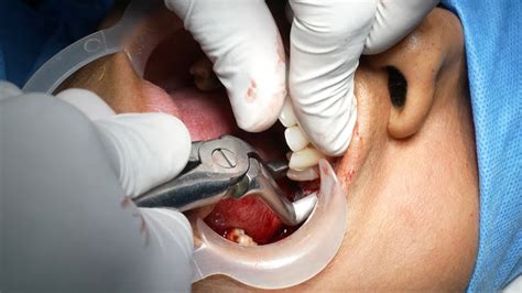 Surgical Tooth Extraction - Extreme Decay of tooth - Dental Clinic