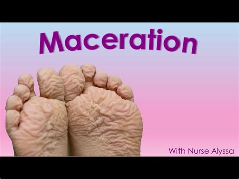 Skin Maceration