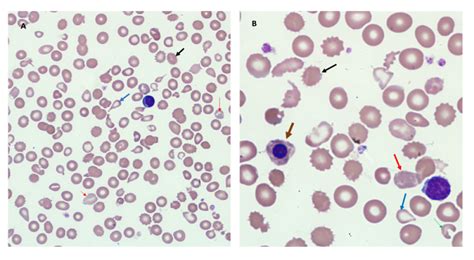 Cureus | A Rare Case of Hemoglobin E/Beta-Thalassemia and Systemic Lupus Erythematosus