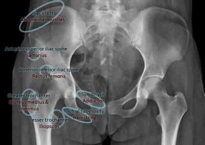 OrthoKids - Pelvic Avulsion Fractures