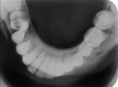 OCCLUSAL RADIOGRAPH 15 | Buyxraysonline