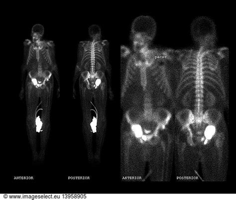 Pelvic Fractures Pelvic Fractures, Bone Scan,abnormal bone scan,abnormal nuclear,bone scan ...
