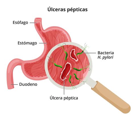 Definición y hechos sobre las úlceras pépticas (úlceras estomacales o duodenales) - NIDDK