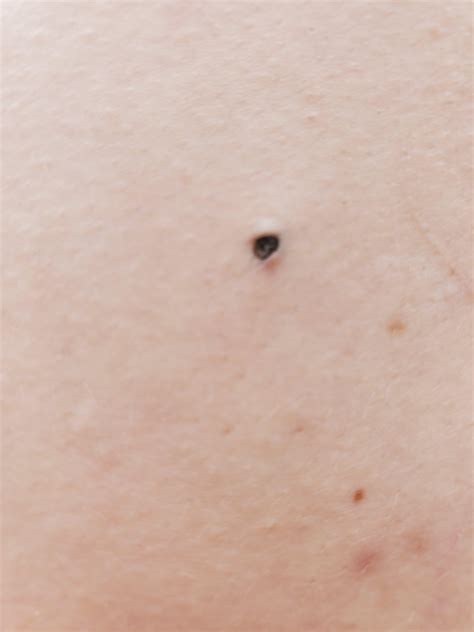 Found this on my back. Any idea what it is? : r/DermatologyQuestions