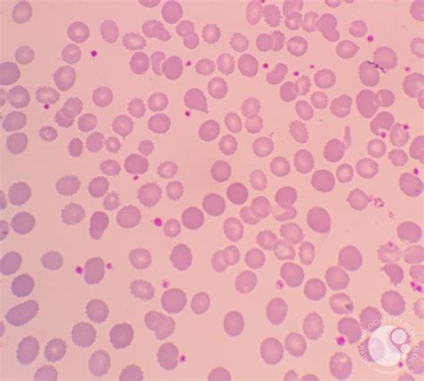 Dimorphic anemia presentation in patient with iron deficiency 4