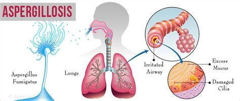 Fungal Disease - Microbiology Notes