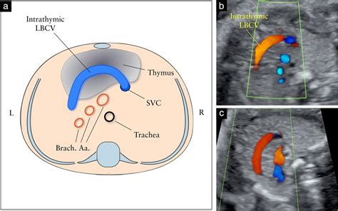 Intrathymic and other anomalous courses of the left brachiocephalic vein in the fetus - Karl ...