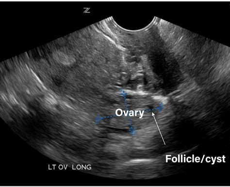 Normal Uterus Transvaginal Ultrasound