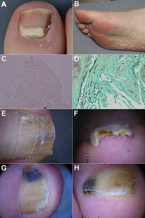 | (A) Proximal subungual onychomycosis in a patient with systemic lupus ...