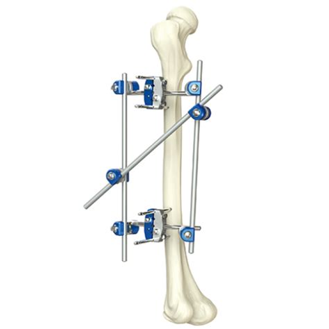 Tibia & Percone External Fixator - Orthopromed Inc.