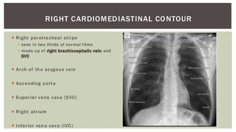 Normal mediastinum radiograph