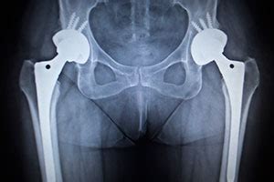 X-ray Guided Hip Replacement | Advanced Orthopaedics & Sports Medicine, Orthopaedic Specialists ...