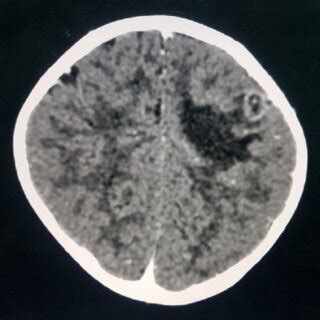 Contrast enhanced CT scan of brain shows ring enhancing lesion in left... | Download Scientific ...