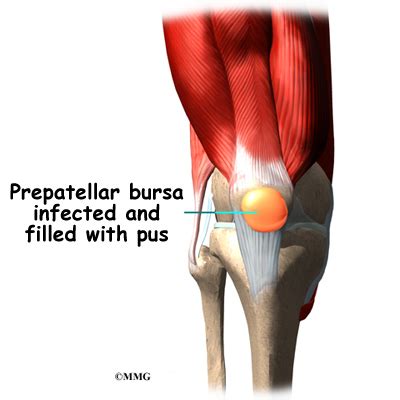 Prepatellar Bursitis: Treatment & More | Houston Methodist