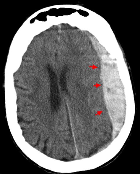 Intracranial Hemorrhage - Cause, Symptoms, Diagnosis, Treatment