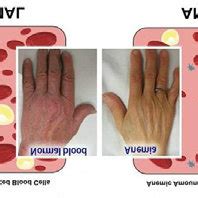 Schematic of the normal range of blood against the anemia range of ...