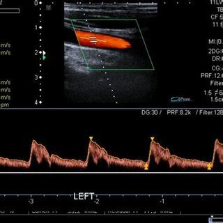 Left common carotid artery (left CCA) -color Doppler ultrasound study ...