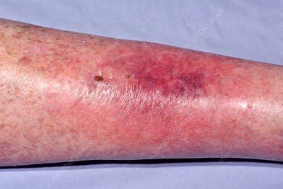Cellulitis of the leg - Stock Image - C034/5306 - Science Photo Library