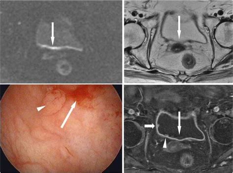 A 53-year-old woman had gross hematuria due to bladder cancer. Axial ...