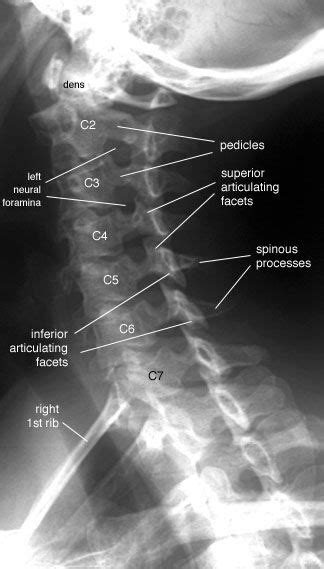 Cervical Spine X-ray | Cervical Spine -- Left Anterior Oblique View ...