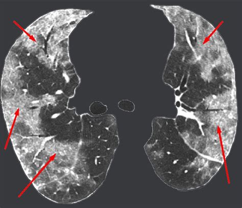 Ground Glass Opacities | New Health Advisor