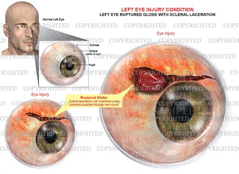 Eye Injury - ruptured globe with scleral laceration – Medical Art Works