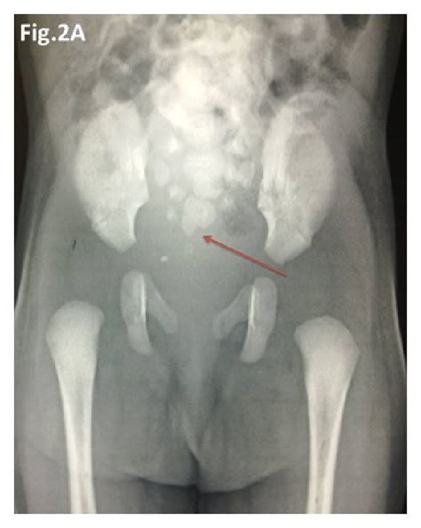 Radiographs of the patient showing partial sacral agenesis (red arrow ...