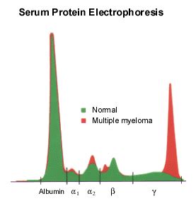 Multiple Myeloma or Plasmacytoma