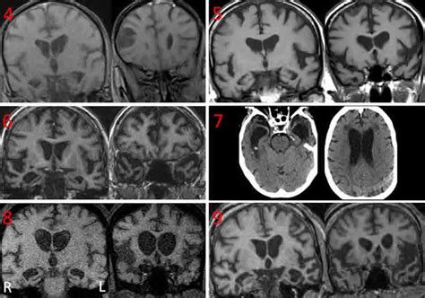 Brain Scans of Dementia Patients with Coprophagia Showed ...