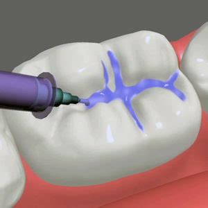 PIT AND FISSURE SEALANTS THERAPY | Schubbs Dental