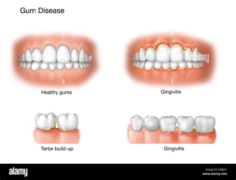 Unhealthy Gums With Braces